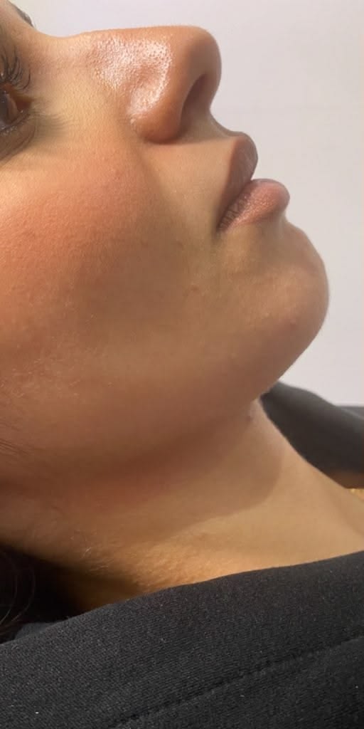Dermal Fillers Before treatment at Dexa Clinic